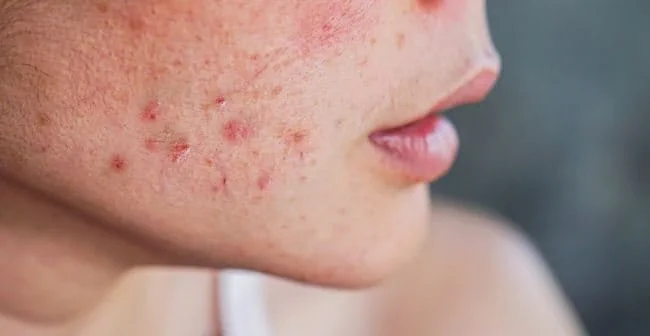 Vì Sao Da Mụn Dùng Serum Lại Dễ Nổi Mụn? Nguyên Nhân Và Cách Khắc Phục