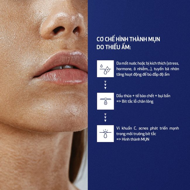 Da Dầu Mụn Mùa Hè Có Cần Dưỡng Ẩm Không? Góc Nhìn Từ Chuyên Gia