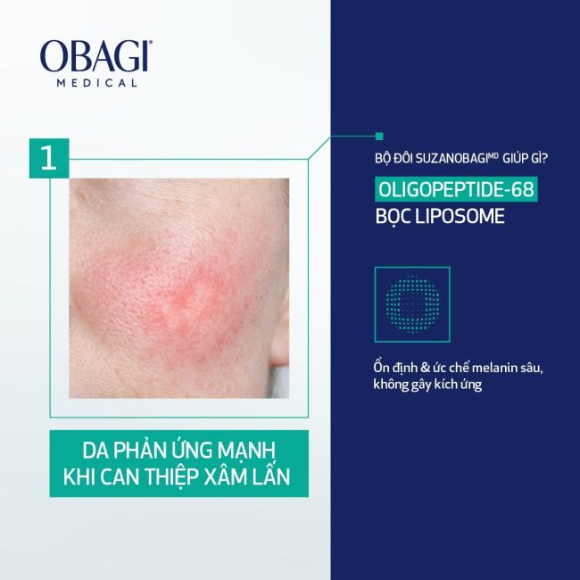 Da Nhạy Cảm Mãi Không Hết Nám? 3 Nguyên Nhân Khiến Nám Dai Dẳng