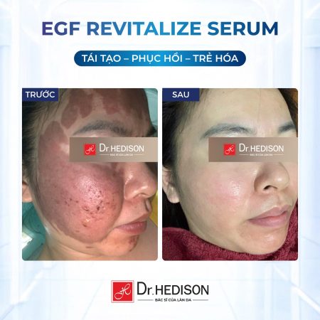 Huyết thanh tái tạo tế bào gốc Dr.Hedison EGF Revitalize Serum