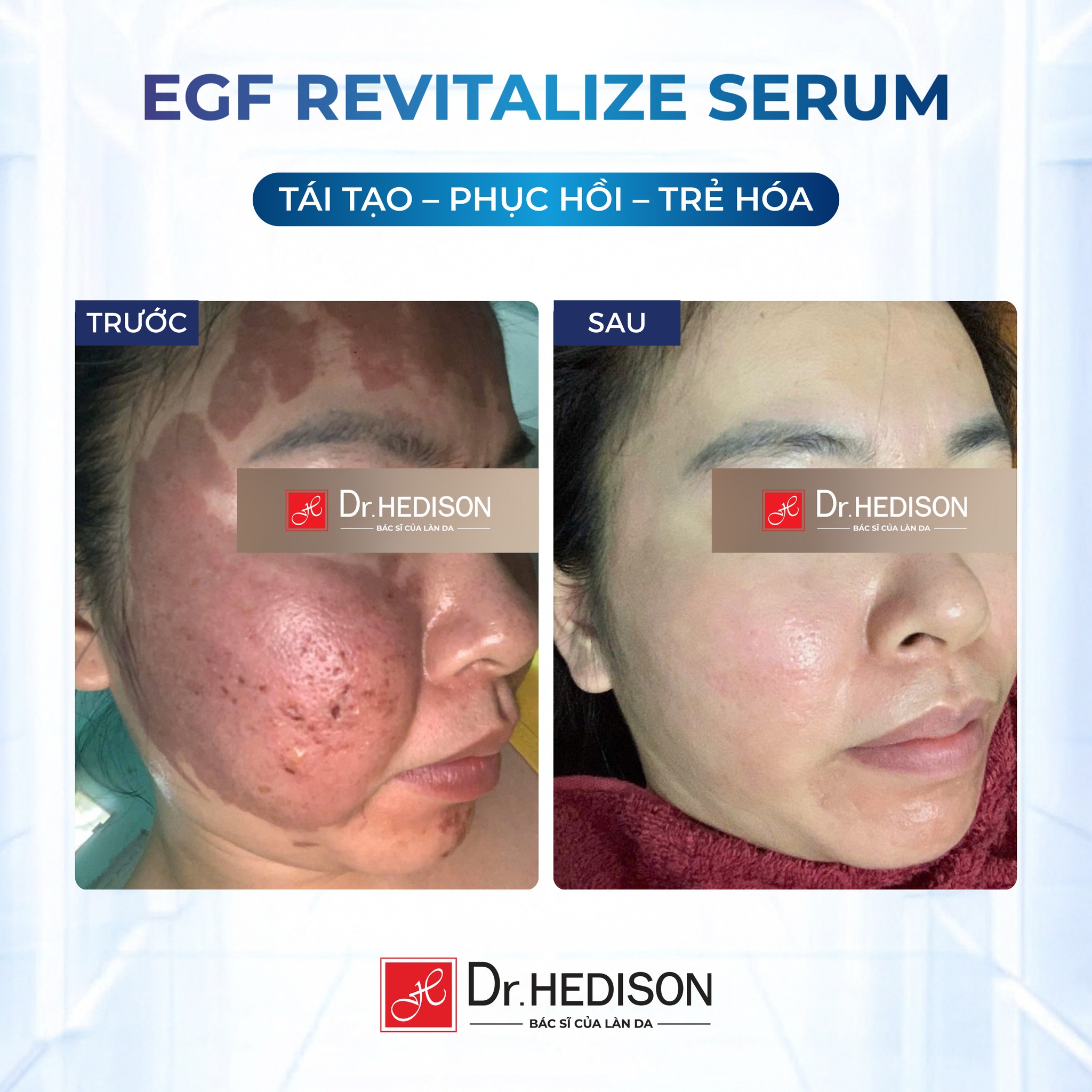 Huyết thanh tái tạo tế bào gốc Dr.Hedison EGF Revitalize Serum