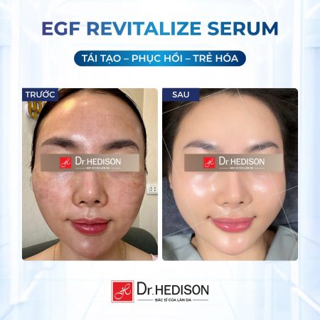 Huyết thanh tái tạo tế bào gốc Dr.Hedison EGF Revitalize Serum