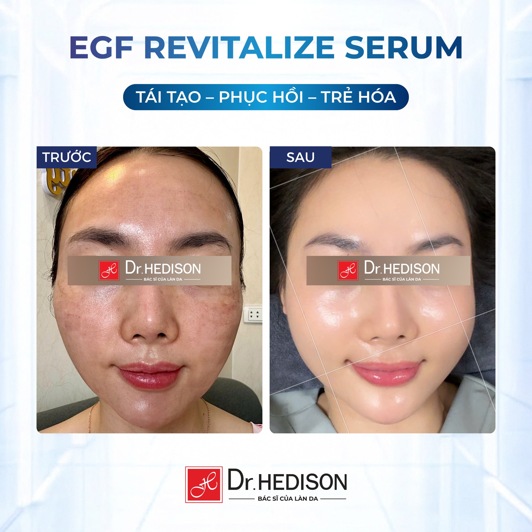 Huyết thanh tái tạo tế bào gốc Dr.Hedison EGF Revitalize Serum