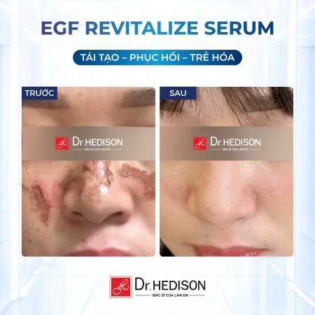 Huyết thanh tái tạo tế bào gốc Dr.Hedison EGF Revitalize Serum