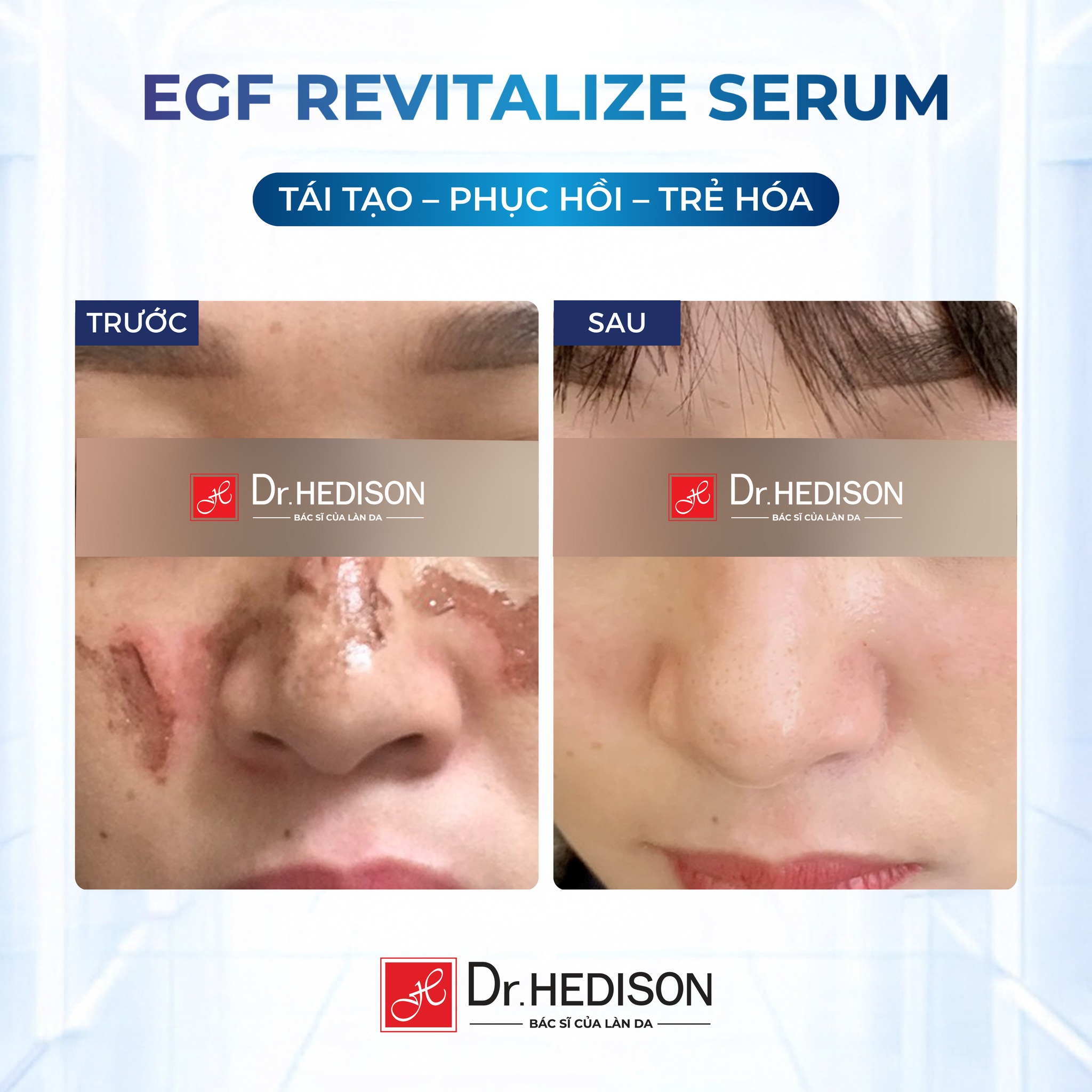 Huyết thanh tái tạo tế bào gốc Dr.Hedison EGF Revitalize Serum