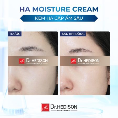 Kem dưỡng ẩm Dr.Hedison Hyaluronic Acid Moisture Cream