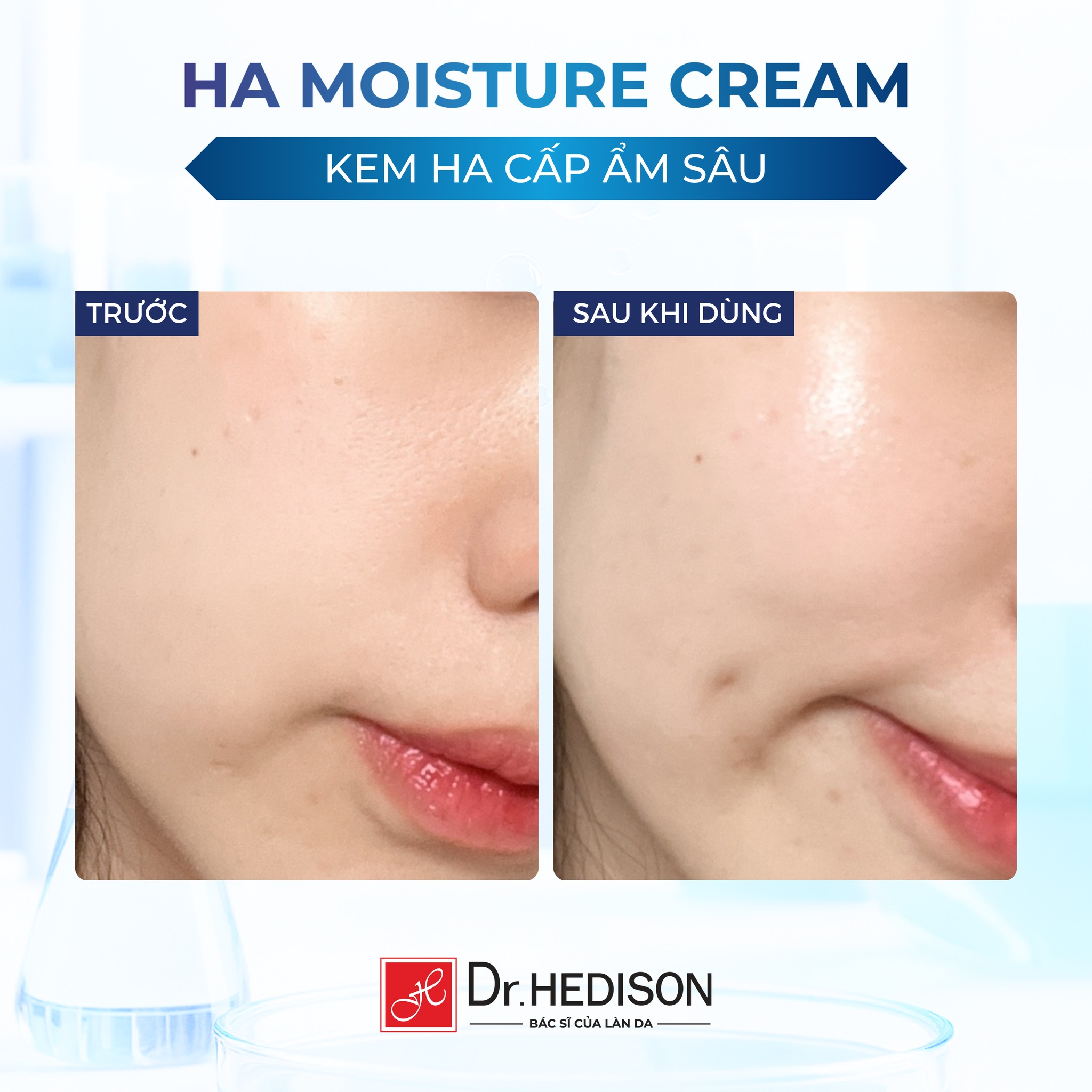 Kem dưỡng ẩm Dr.Hedison Hyaluronic Acid Moisture Cream