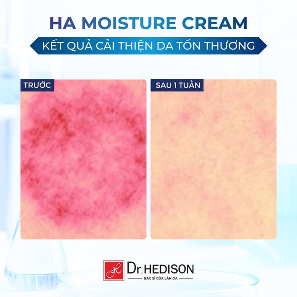 Kem dưỡng ẩm Dr.Hedison Hyaluronic Acid Moisture Cream