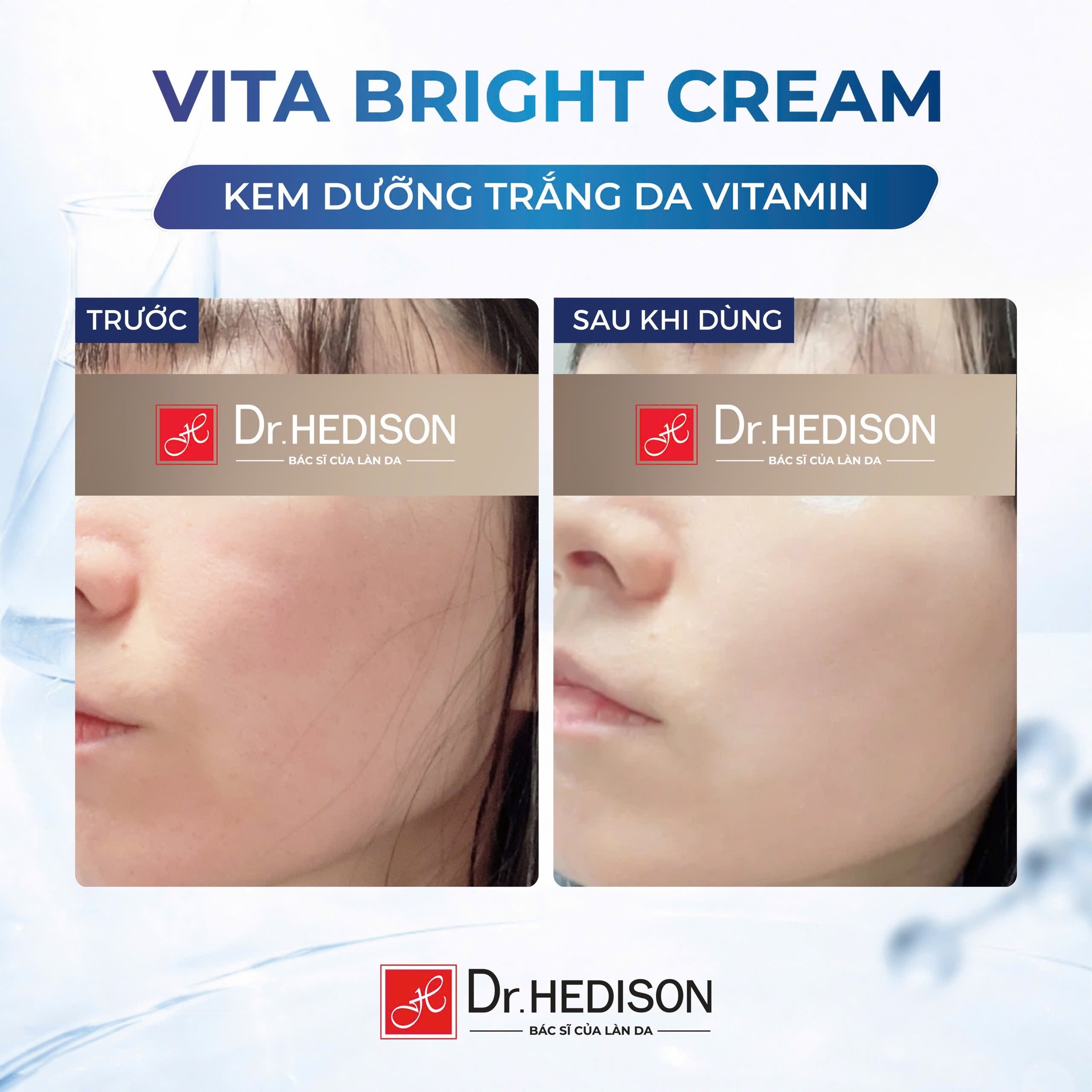 Kem dưỡng trắng da Dr.Hedison Vita – Bright Cream