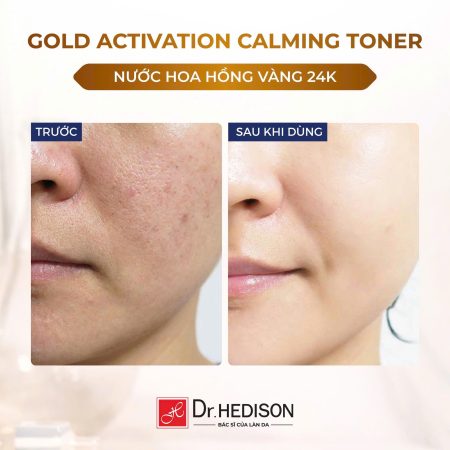 Nước hoa hồng tinh chất vàng Dr.Hedison Gold Activation Calming Toner
