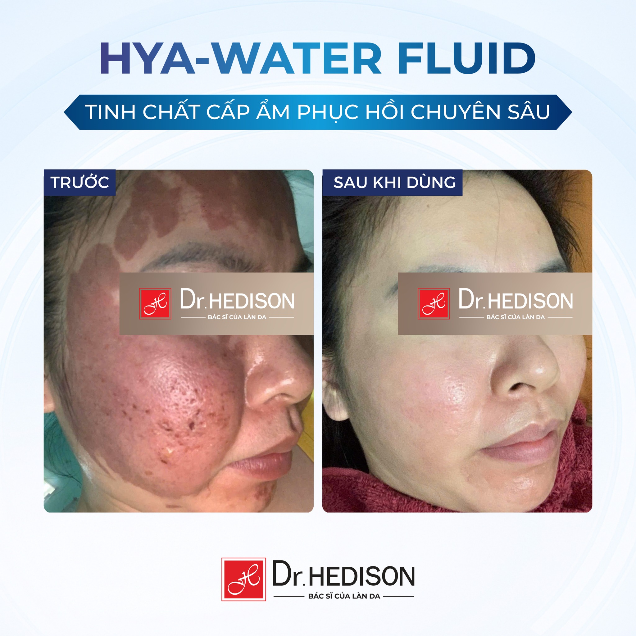 Tinh chất cấp nước dưỡng ẩm da Dr.Hedison Hya – Water Fluid