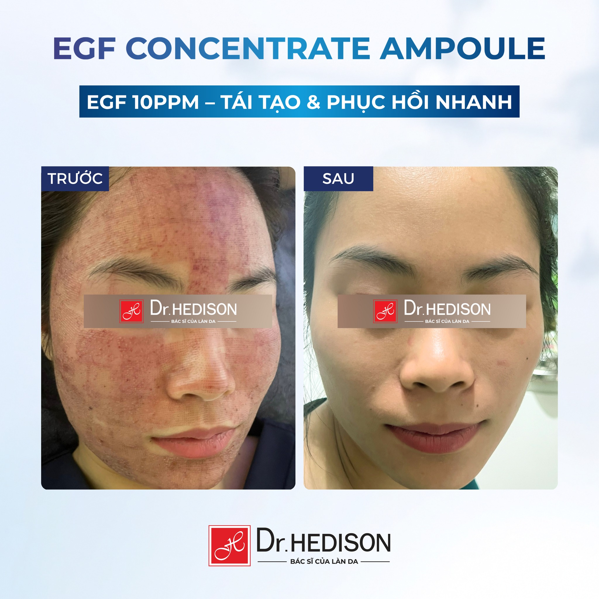 Tinh chất siêu tái tạo tế bào gốc Dr.Hedison EGF Concentrate Ampoule