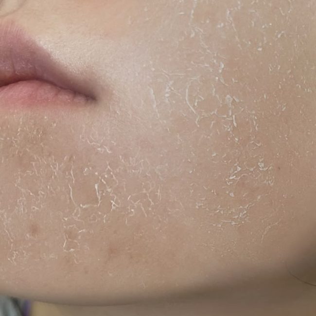 Dùng Retinol Bị Bong Tróc Có Phải Đang Hiệu Quả